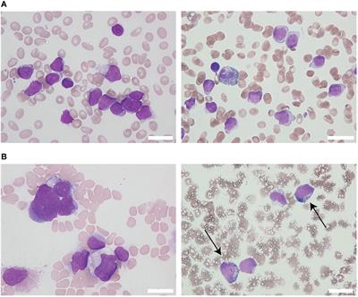 Repeated Lineage Switches in an Elderly Case of Refractory B-Cell Acute Lymphoblastic Leukemia With MLL Gene Amplification: A Case Report and Literature Review